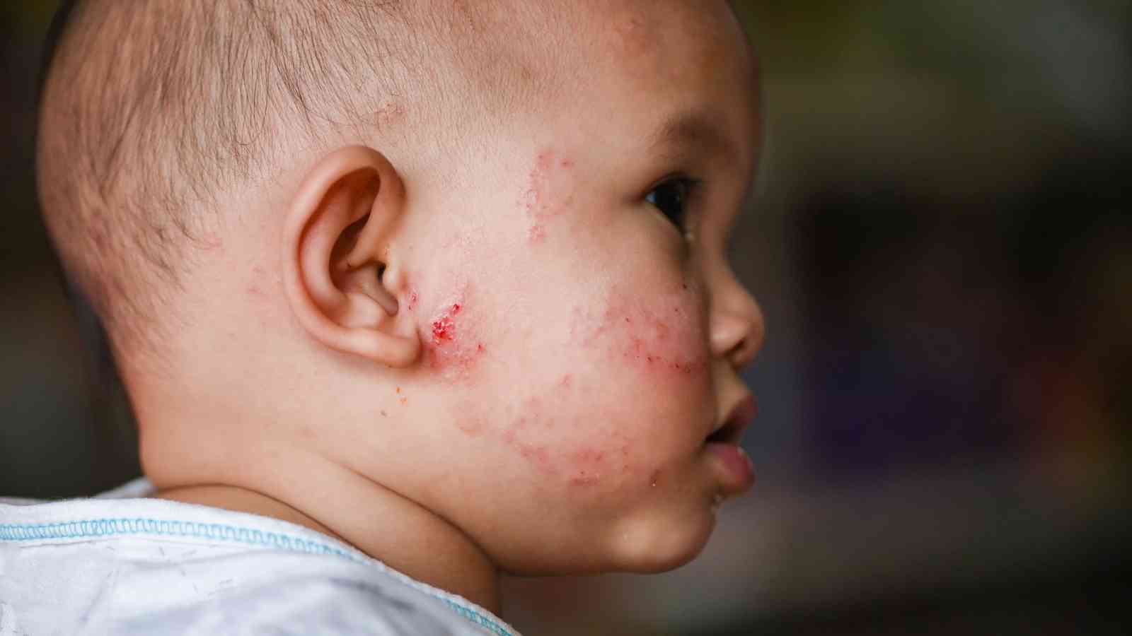 Close-up of a young child with a rash or skin irritation on the side of their face, particularly near the ear and cheek.