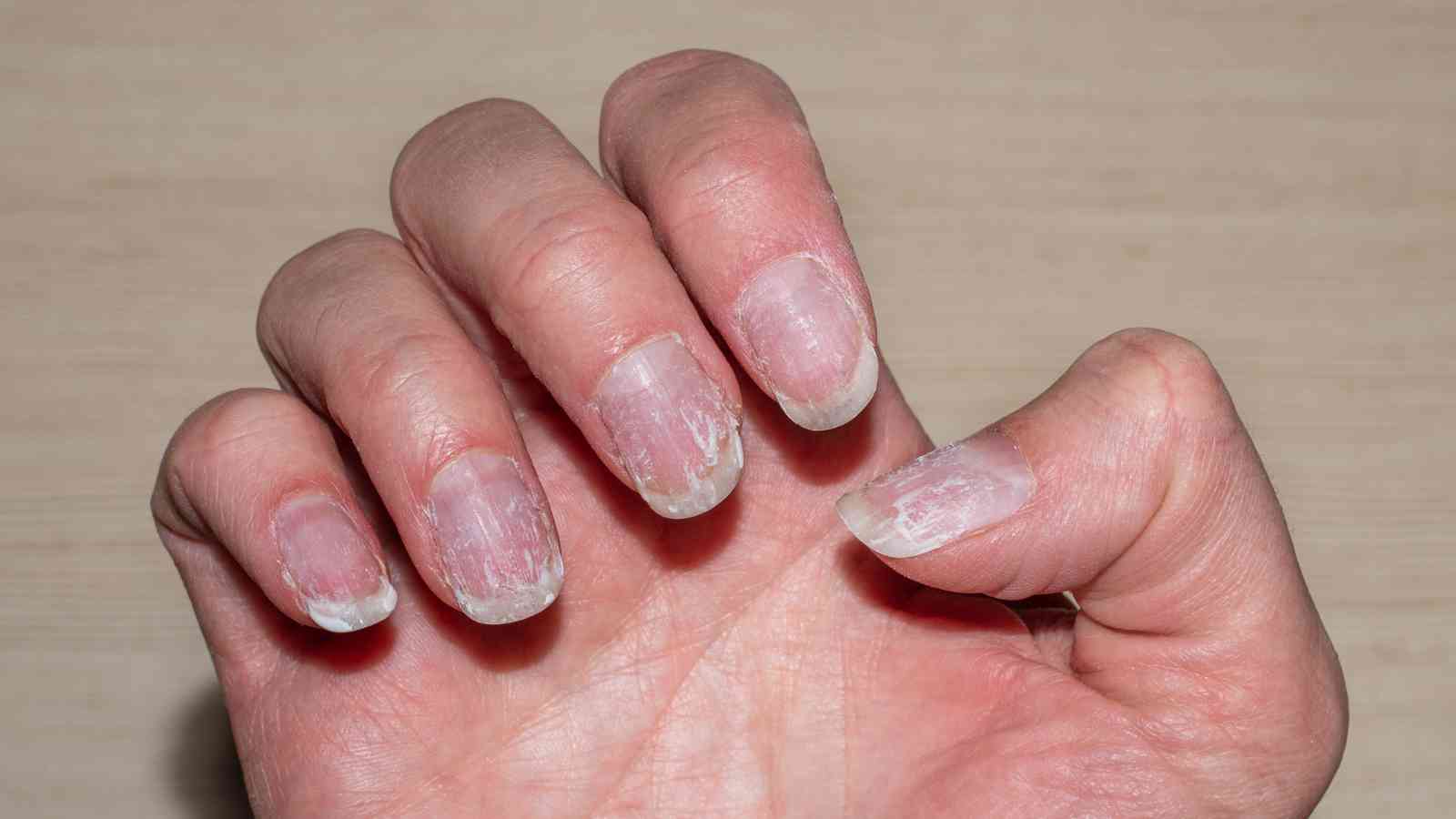 A close-up of a hand showing fingernails with peeling, damage, and rough surfaces against a plain background.