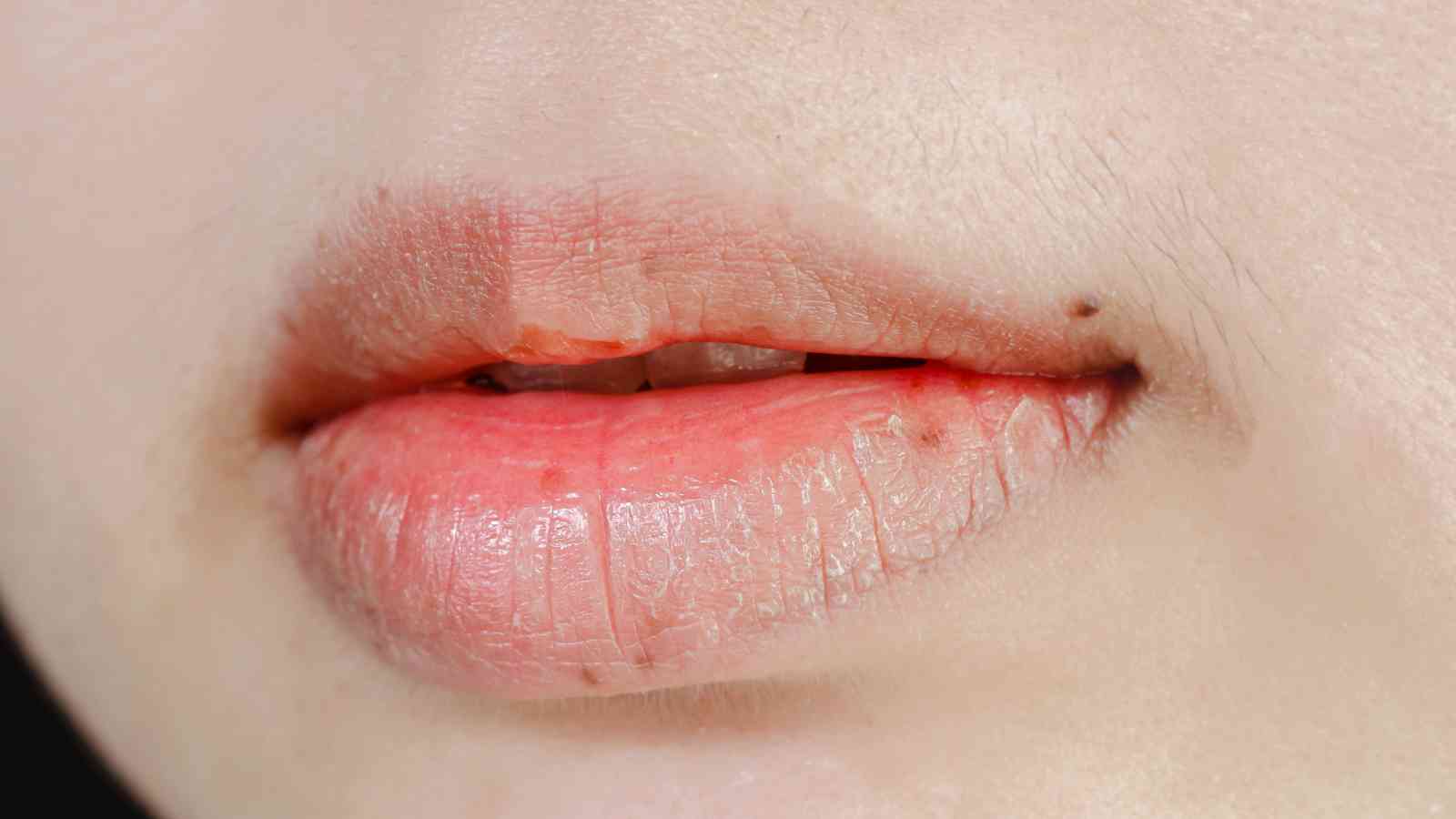 Close-up of a person's lips with slight dryness and cracking, a small mole above the upper lip, and faint facial hair visible.