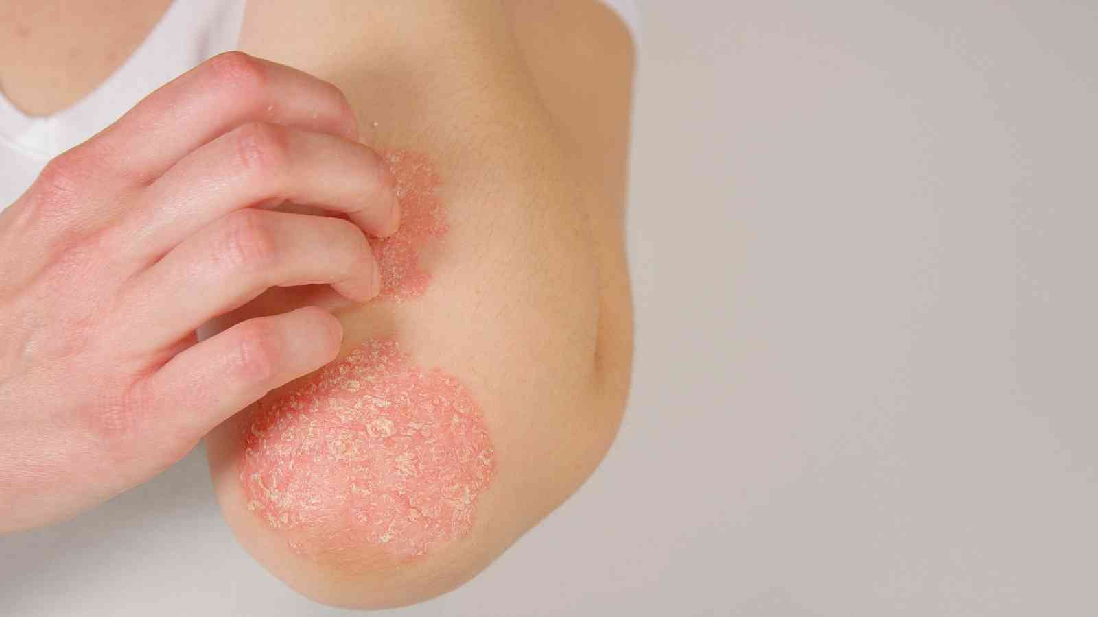 A person scratching red, scaly patches on their elbow, possibly showing symptoms of a skin condition such as psoriasis.