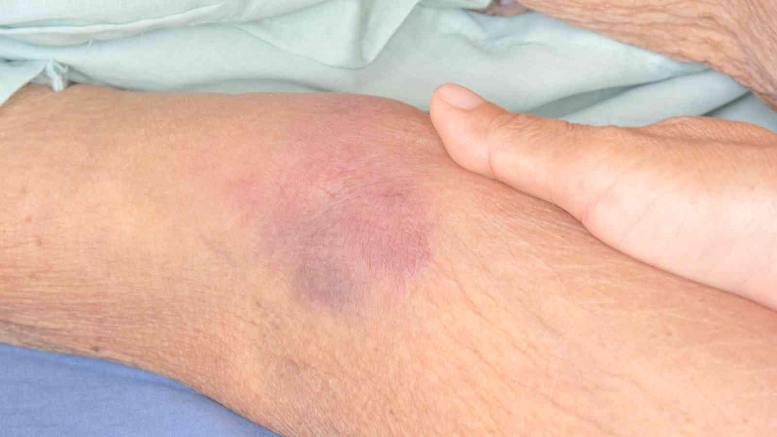A close-up of a person’s skin showing a purple bruise with some redness and a hand gently resting nearby.